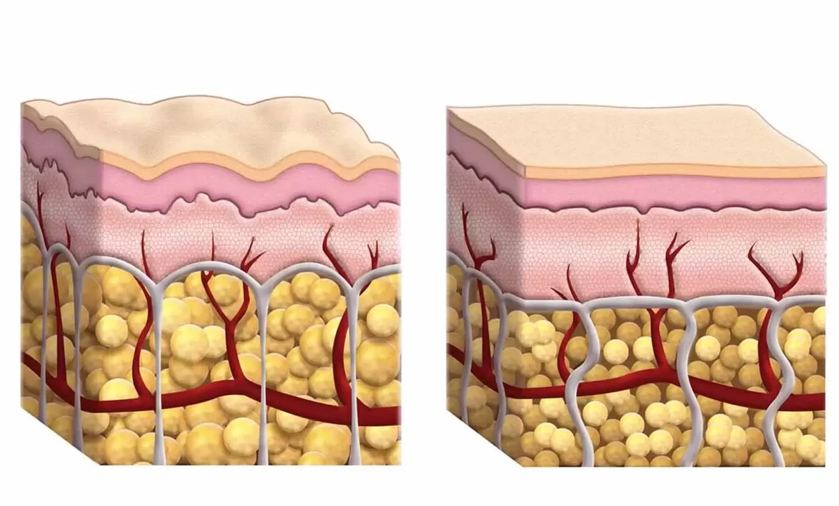 Fat cells while using Keto Guru